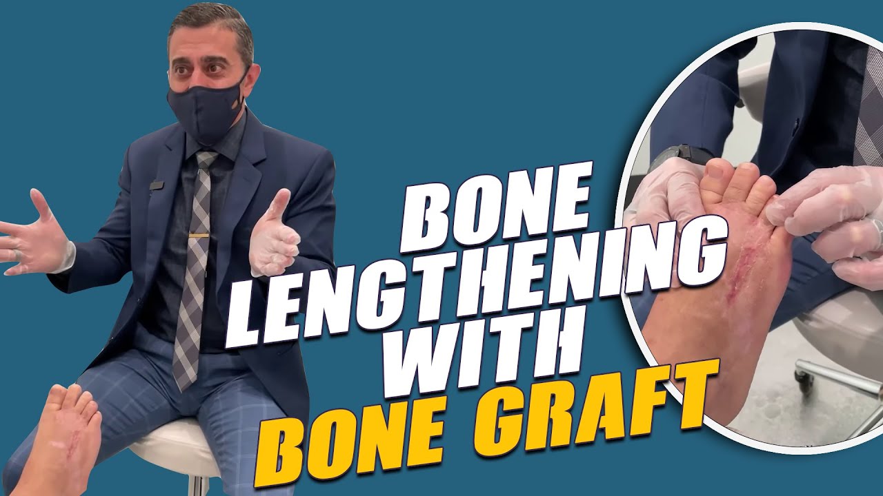 Toe Lengthening With Bone Graft 3-Month Post-Op
