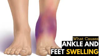 What Causes Ankles & Feet Swelling | Diagnosis & Treatment
