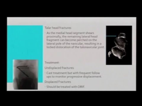 Peripheral Talar Fractures