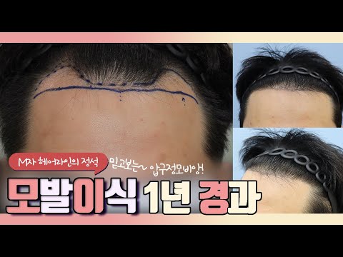 20대 후반 남성,비절개 2200모, M자 모발이식 1년 경과영상!