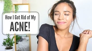 GET RID OF YOUR ACNE FOREVER! SERIOUSLY WORKS!
