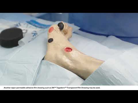 Application tips: 3M™ V.A.C.® Dressing Application Bridging Technique on Foot Wound