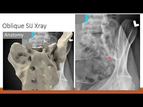 MRI of the sacroiliac joint