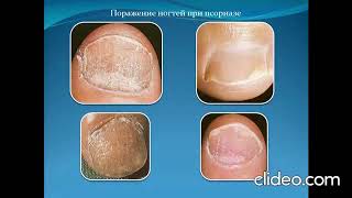 Папулезные дерматозы