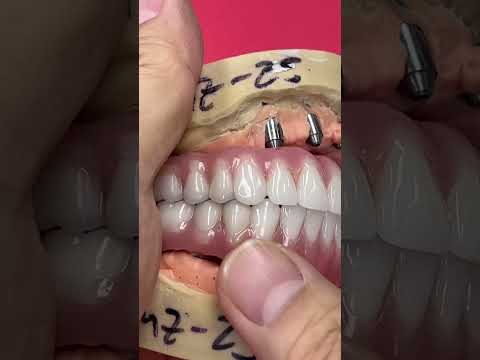 Full Mouth Implants