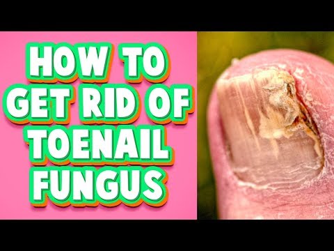 Ari ng lalaki upang tratuhin ang mga halamang-singaw litrato Toenail fungus tablets
