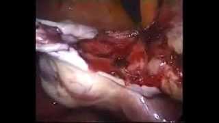 preview picture of video 'laparoscopic management of bilateral dermoide ovarian cyst'