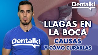 LLAGAS en la boca - Cómo curarlas y por qué salen las AFTAS bucales | Dentalk! ©