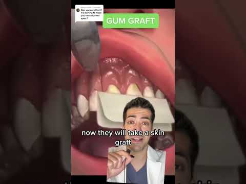 #greenscreenvideo Gum grafting is a procedure done to treat gum, recession and sensitivity