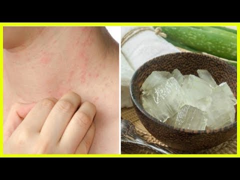 Die Lotion fufan für die Behandlung der Schuppenflechte Wie rosa zu unterscheiden entziehe auch die Schuppenflechte