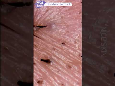 Blackhead removal #24 #blackheadremoval #blackheads #블랙헤드 #sebum #블랙헤드제거