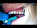 Right & Left Ultrasonic Tips