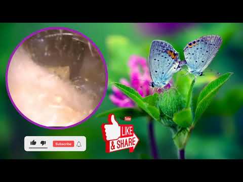 Blocked Ear Wax Removal using Jobson Horne aka