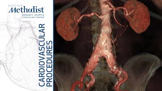 Download Lagu Iliac Branch Endograft (Alan B. Lumsden, MD, Ponraj Chinnadurai, MBBS) Thumbnail