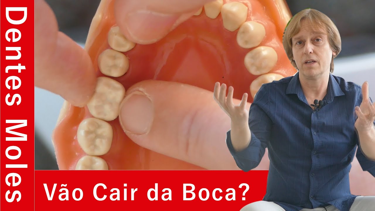 Dentes Moles - Como Saber Se Tenho Dentes Moles, Se Irão Cair da Boca e Como Tratar Sem Implantes?