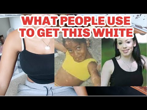 Benoquin 20% monobenzone cream, packaging size: 30 gm