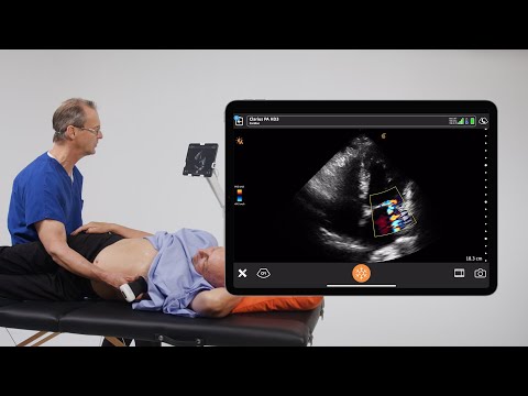 The Appearance of Mitral Regurgitation
