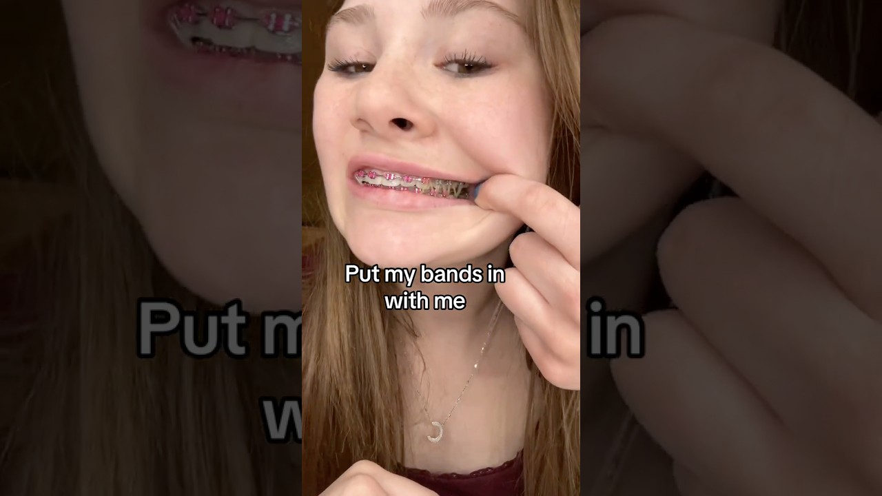 How these Rubber Bands Help get your Braces Off!