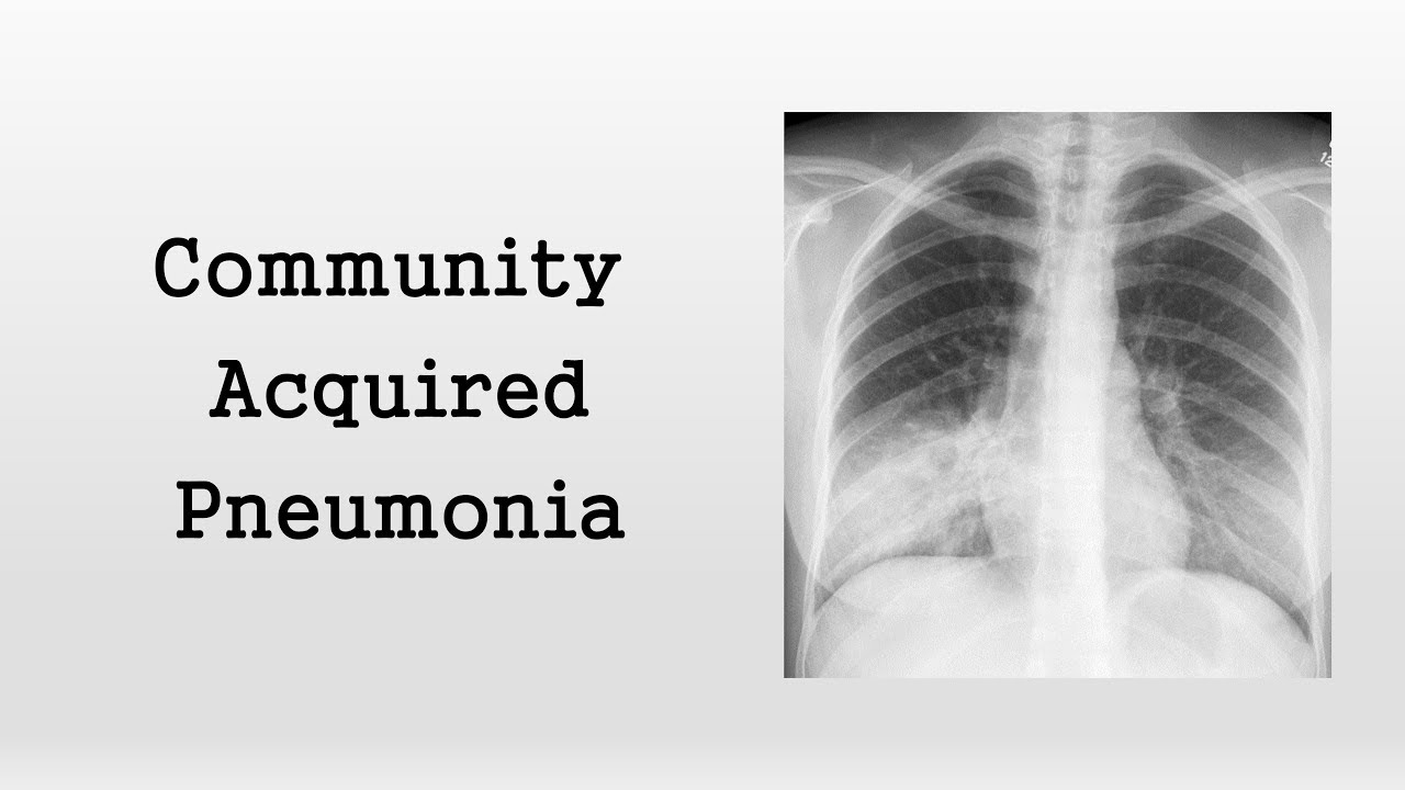 Community Acquired Pneumonia
