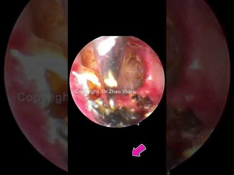 EAR WAX REMOVAL #Shorts #773