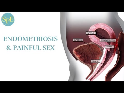 Video 2: Endometriosis & Painful Sex