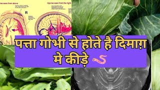 Is cabbage🥬 causing brain oedema||क्या पत्तागोभी खाने से होते है dimag🧠मे कीड़े 🪱#trending #youtube