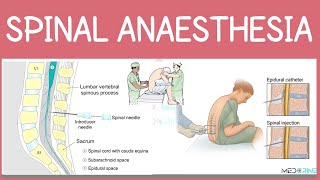 Spinal Anesthesia | Procedure, Technique, Drugs, Indications, and Complications Made Simple