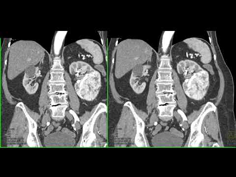 CT of the Acute Abdomen: GU Applications Part 1