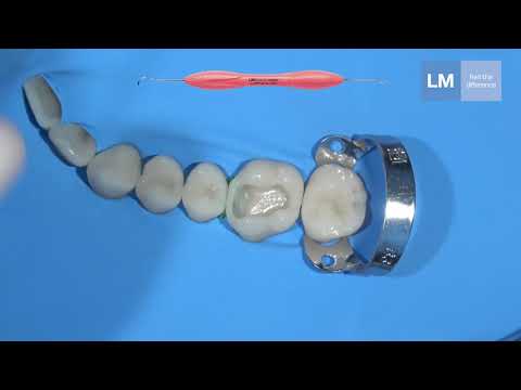 Style Italiano LM Arte Posterior Misura, a unique dental instrument