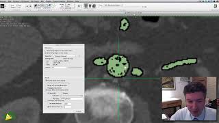 Segmentação Aórtica