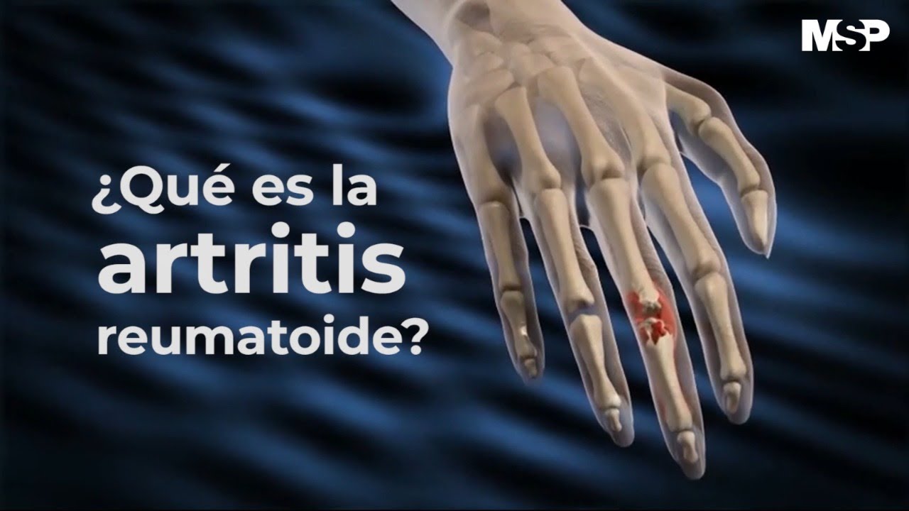 Artritis Reumatoide - #ExclusivoMSP