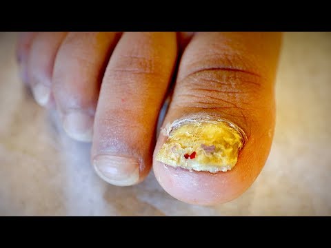 Presyo ekzoderil sa Permyan Kuko halamang-singaw ay isang anak ng 9 na buwan