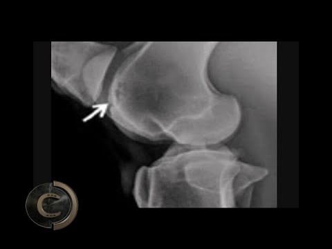 Farina davena per le articolazioni Male tutti i giunti e le membra gonfie