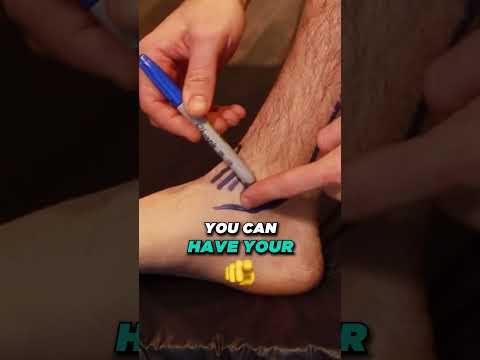 Why Is My Sprained Ankle Still Swollen After 3 6 or 12 MONTHS