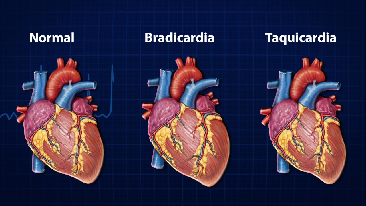 Doenças do Coração -  Arritmia Cardíaca