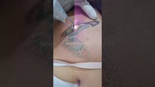 Download lagu Hapus tato oleh Rumah Hapus tato #shorts #hapustato #tattooremoval #lasertattooremoval #tato mp3