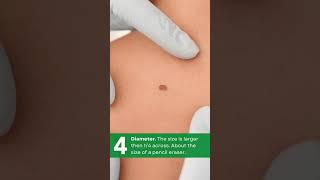 Download lagu Spotting Skin Cancer mp3 Download lagu Spotting Skin Cancer mp3