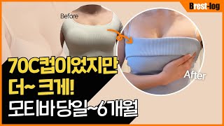 모티바 가슴성형 후기, 70C컵이었지만 더 크게! 당일부터 6개월까지의 과정 ✨