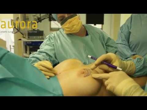 Bilateral Nipple/Areola Scar Revision