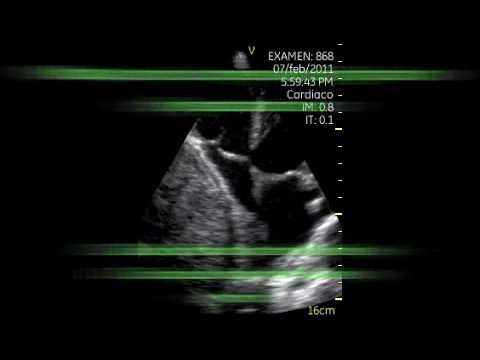 Extrinsic Compression Of Right Atrium - Hepatocellular Carcinoma