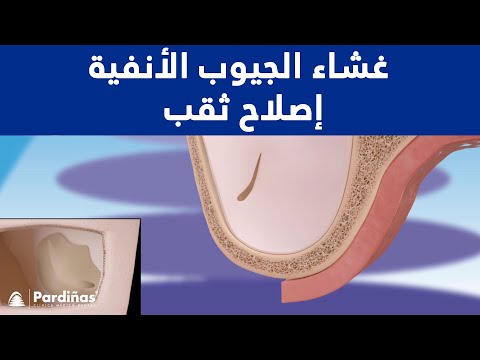 غشاء الجيوب الأنفية إصلاح ثقب ©