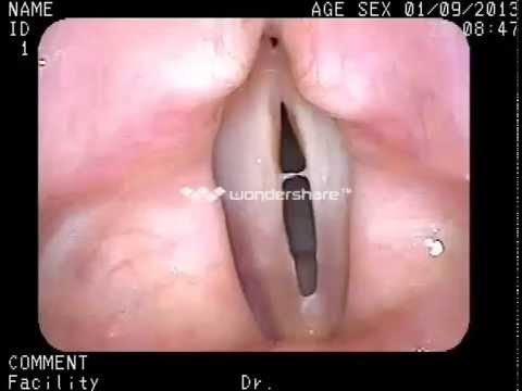 vocal cords victim of  acid reflux