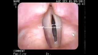 vocal cords victim of  acid reflux