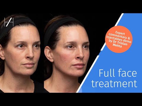 Full Face Dermal Fillers Treatment Demonstration by Dr Tristan Mehta