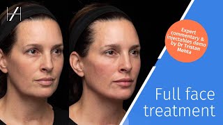 Full Face Dermal Fillers Treatment Demonstration by Dr Tristan Mehta