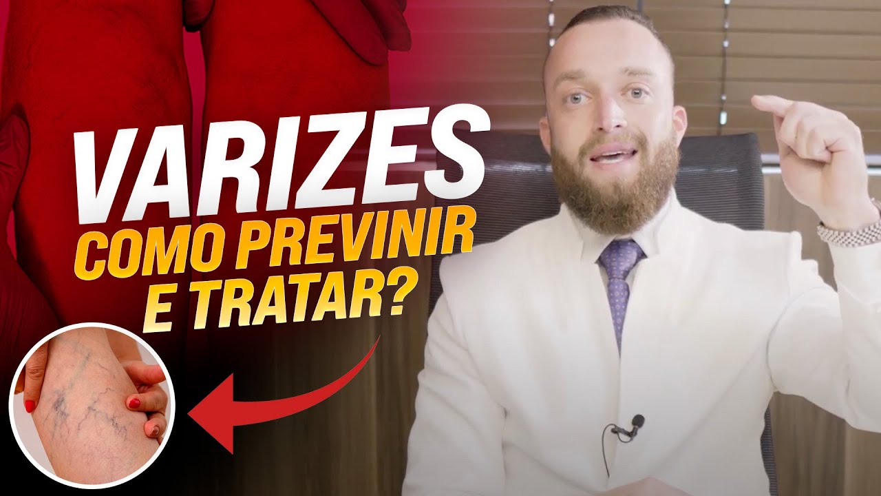 Como PREVENIR e TRATAR Varizes? Da para evitar?