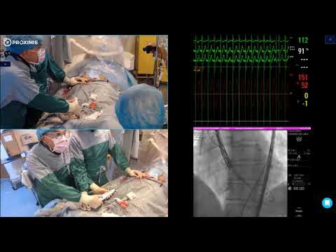 Live in a Box TAVI with the new portico FlexNav system