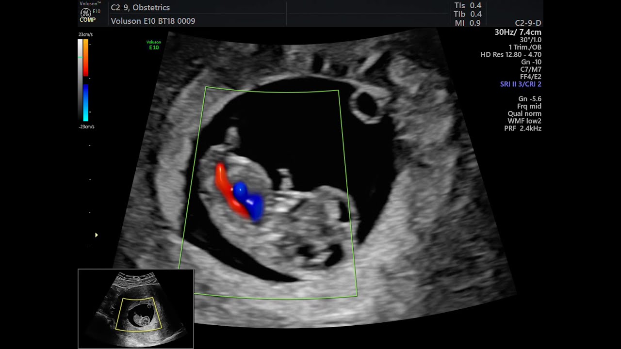AVALIAÇÃO DE GESTAÇÃO INICIAL DE 10 SEMANAS