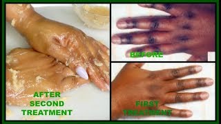 HOW TO CLEAR DARK ROUGH KNUCKLES | POTATO AND BROWN SUGAR FOR CLEAR SOFT HANDS |Khichi Beauty