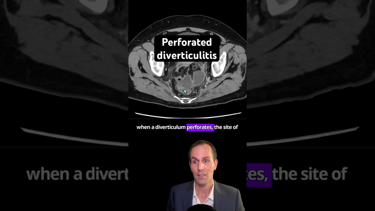 Abdominal CT Tutorials - Perforated diverticulitis